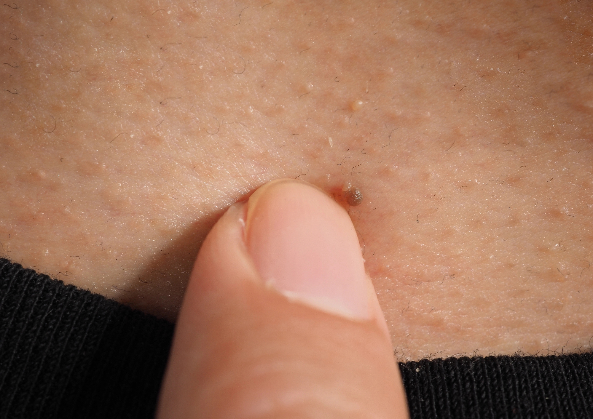 Moja izkušnja: odstranitev znamenja brez strahu